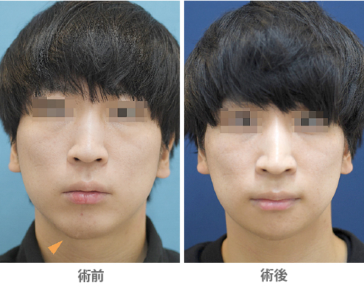 「おとがい形成(顎先の上下短縮+左右差改善)」の症例写真・ビフォーアフター