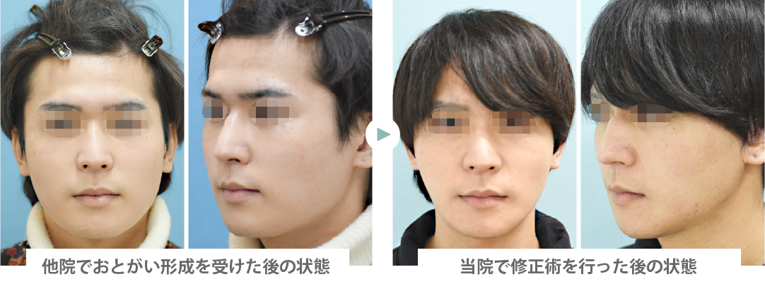 「Vライン形成術(他院オトガイ形成術の修正・やり直し術)」の症例写真・ビフォーアフター