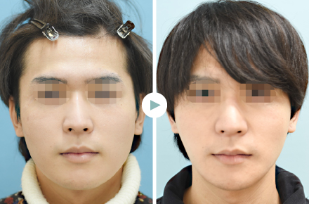 骨切りセカンドオピニオン外来を行っています(CT検査無料)