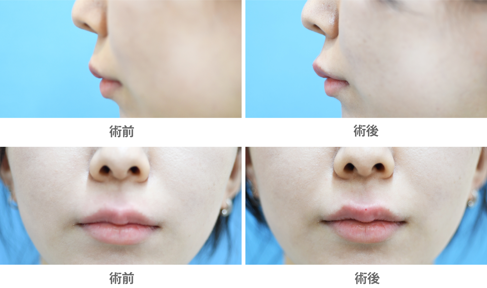 「人中短縮ヒアルロン酸(Cカール形成)」の症例写真・ビフォーアフター