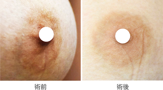 「乳輪の黒ずみ・色むら除去症例」の症例写真・ビフォーアフター