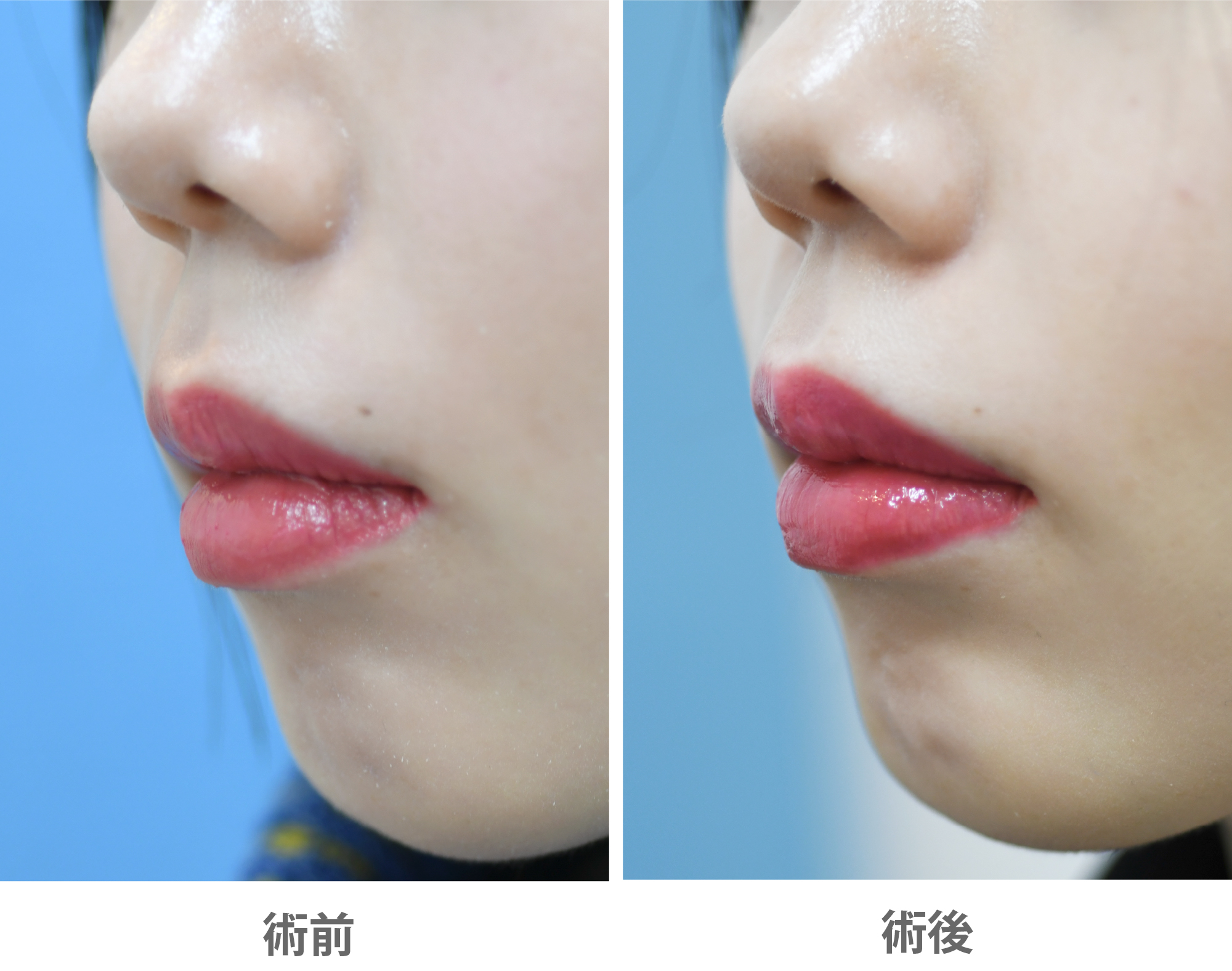 「人中短縮ボトックス」の症例写真・ビフォーアフター