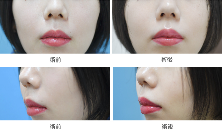 「人中短縮ボトックス」の症例写真・ビフォーアフター