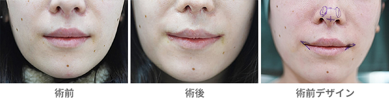 「皮膚切除による口角挙上術(スマイルリップ)」の症例写真・ビフォーアフター