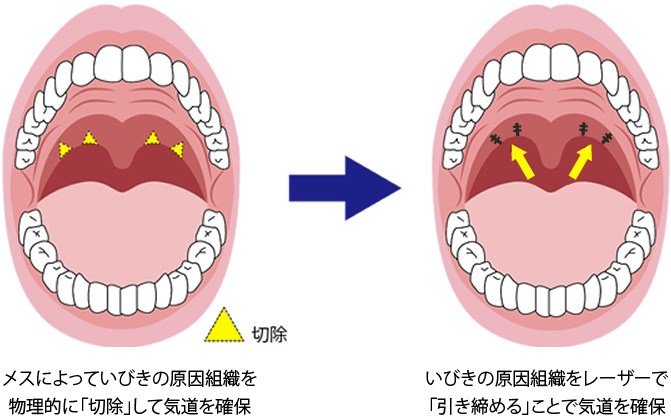 手術/レーザーによるいびき治療のイメージ
