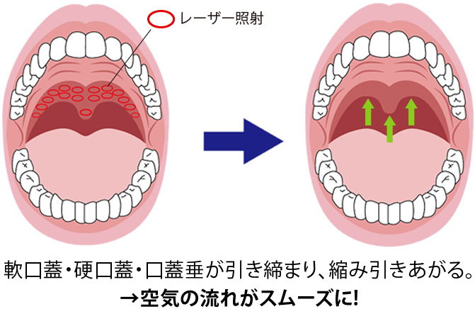 レーザー治療