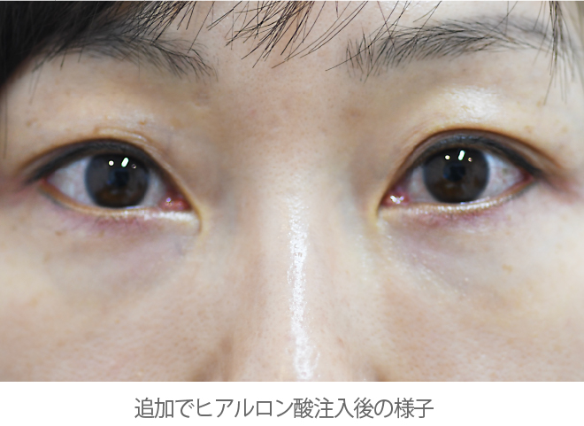 術後②(さらにヒアルロン酸を追加)