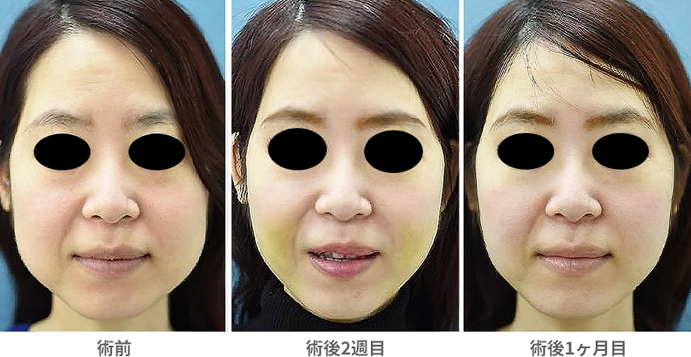 「頬の脂肪吸引」の症例写真・ビフォーアフター