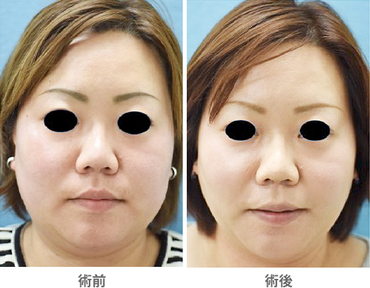 「脂肪吸引(頬/ジョールファット+首)」の症例写真・ビフォーアフター