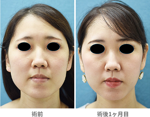 「頬の脂肪吸引」の症例写真・ビフォーアフター