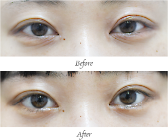 「上まぶたのくぼみ・三重・眼瞼下垂治療（ヒアルロン酸注入）」の症例写真・ビフォーアフター