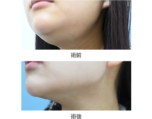 「唾液腺ボトックス(舌下腺・顎下腺)」の症例写真・ビフォーアフター