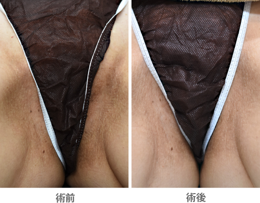 「鼠径部の黒ずみ治療(アレキサンドライトレーザー)」の症例写真・ビフォーアフター