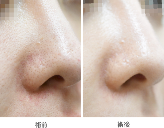 「小鼻の赤み消しレーザー(エリートプラス)」の症例写真・ビフォーアフター