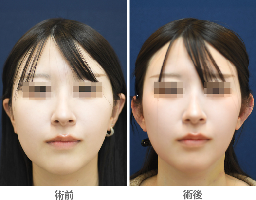 「立ち耳整形・耳起こし(耳珠軟骨移植)」の症例写真・ビフォーアフター
