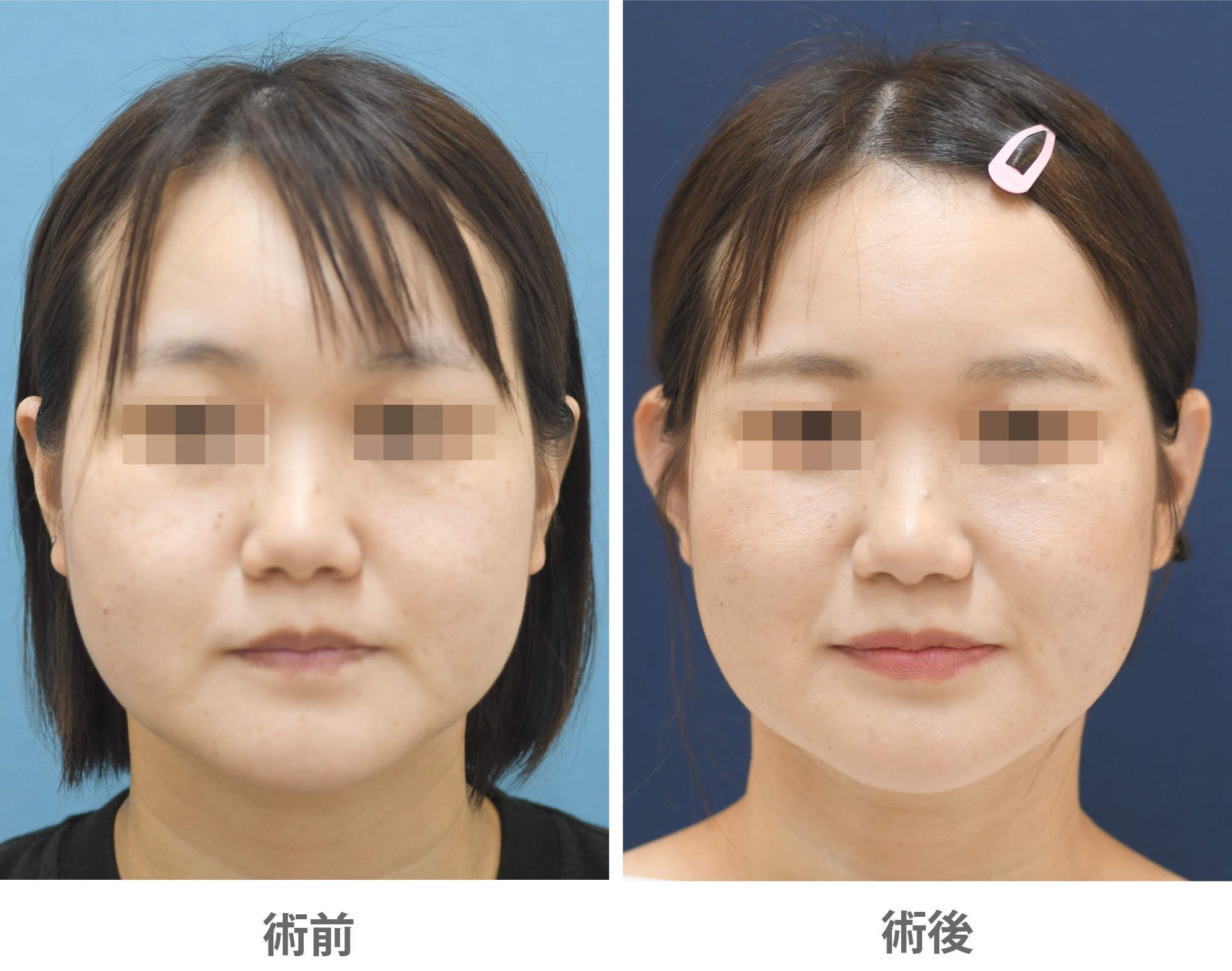 「立ち耳整形(小顔・若返り効果)」の症例写真・ビフォーアフター