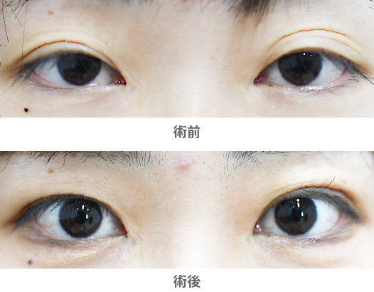 「三重まぶた治療(皮膚切開/ROOF移動固定術)」の症例写真・ビフォーアフター