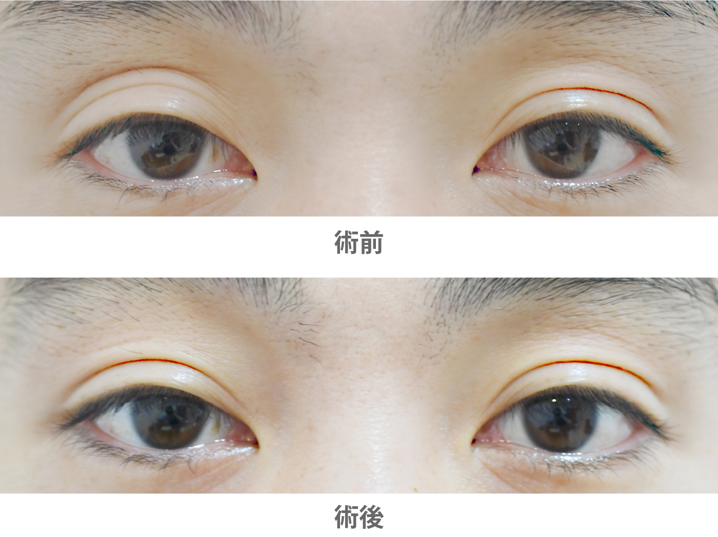 「上まぶたのくぼみ&三重まぶた治療(ヒアルロン酸注入/片目のみ)」の症例写真・ビフォーアフター