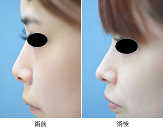 「鼻尖耳介軟骨移植(鼻を高く/オープン法)」の症例写真・ビフォーアフター