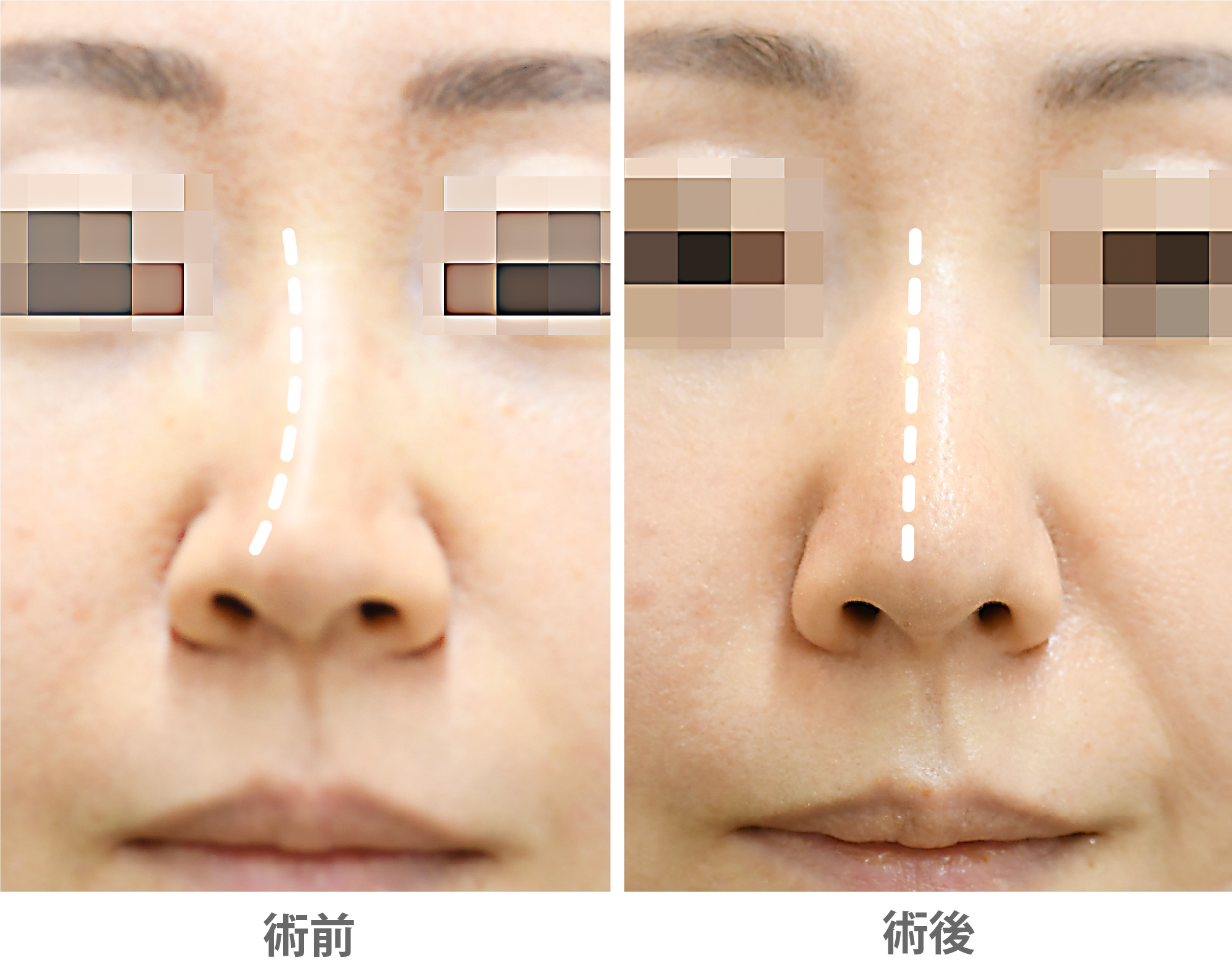 「鼻整形(斜鼻修正+ハンプ修正)」の症例写真・ビフォーアフター