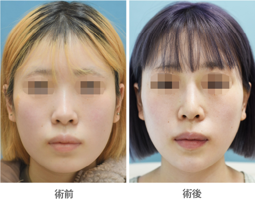 「Vライン形成術(エラ骨切り・下顎下縁形成・おとがい形成)」の症例写真・ビフォーアフター