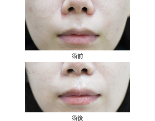 「傷ができない人中短縮術(口腔内切開法)」の症例写真・ビフォーアフター