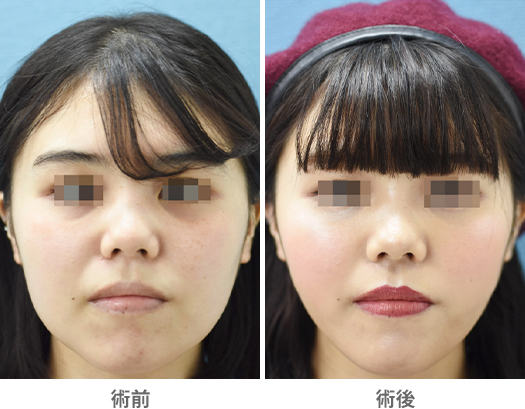 「ジョールファット除去(Vライン形成/ベイザー使用)」の症例写真・ビフォーアフター