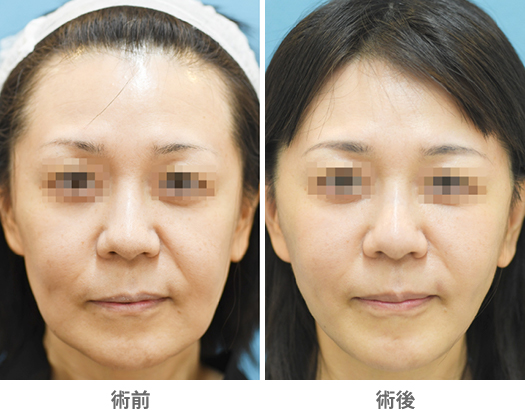 「糸リフト×脂肪吸引(頬のたるみ取り)」の症例写真・ビフォーアフター
